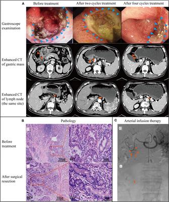 Case Report: Clinical application of continuous arterial infusion chemotherapy in neoadjuvant therapy for locally advanced gastric cancer